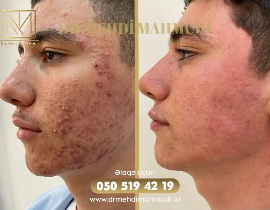 Çapıq - Xəstə8 - Kosmetik Dermatoloq Akne Klinik