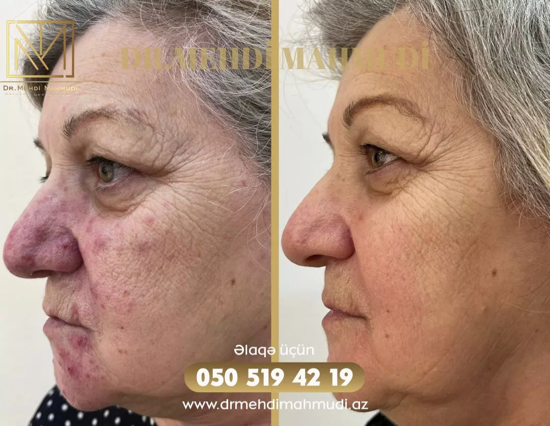 Çapıq - Xəstə4 - Kosmetik Dermatoloq Akne Klinik